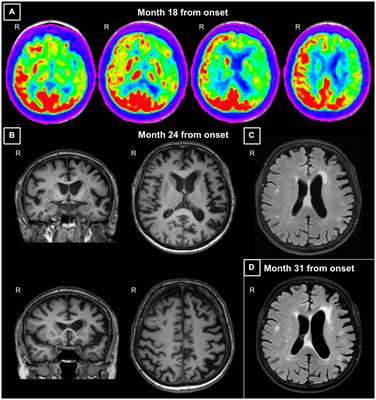 A novel GRN mutation in an Italian patient with non-fluent variant of primary progressive aphasia at onset: a longitudinal case report